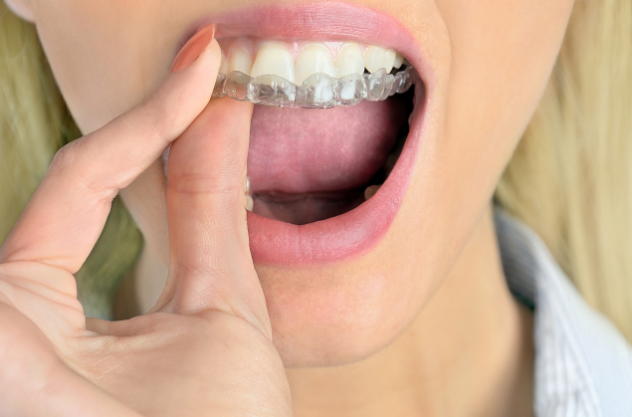 person putting on invisalign clear aligners