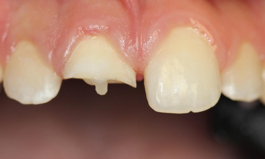 broken front tooth with a post inside