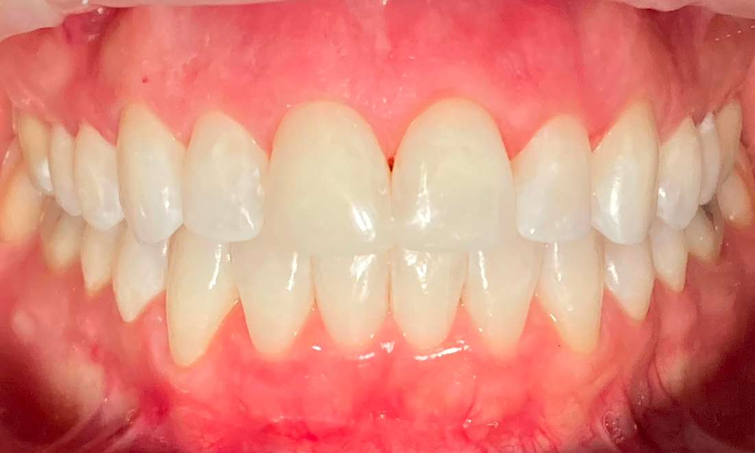 Composite Veneer to fix a broken tooth Before & After Photos Austin TX