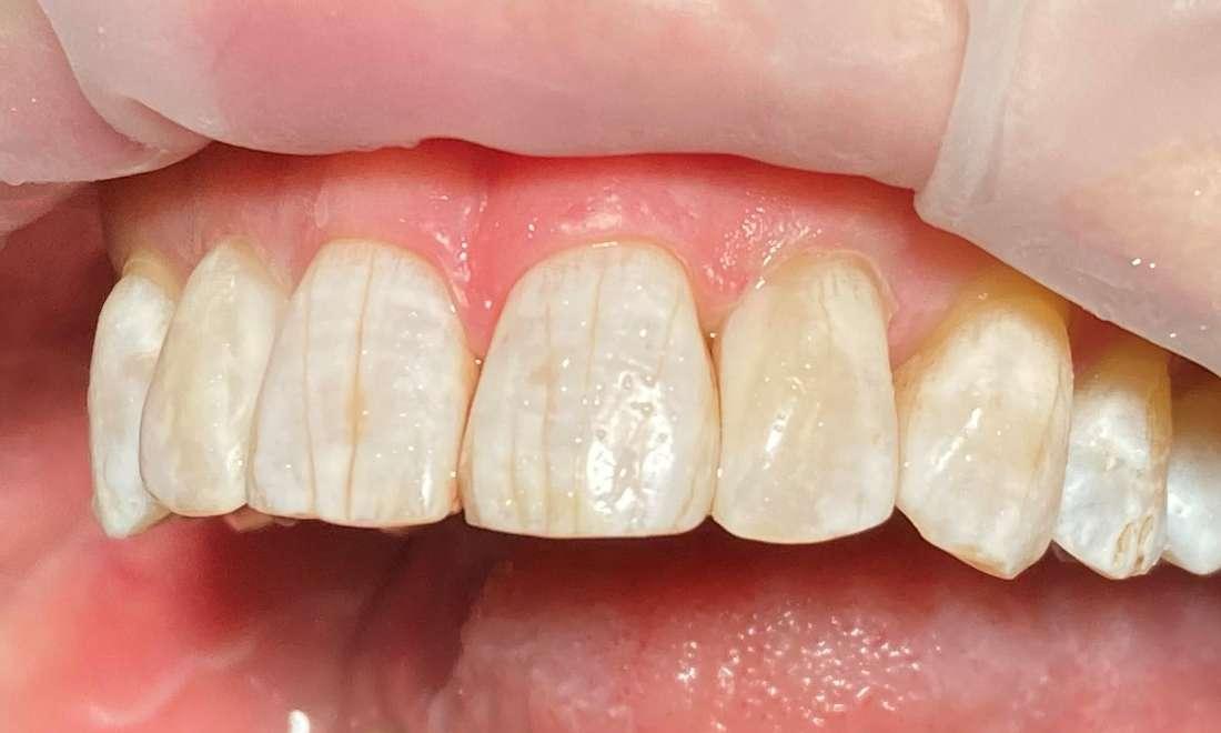 bioclear-to-close-gum-line-black-triangles-of-space-before-after