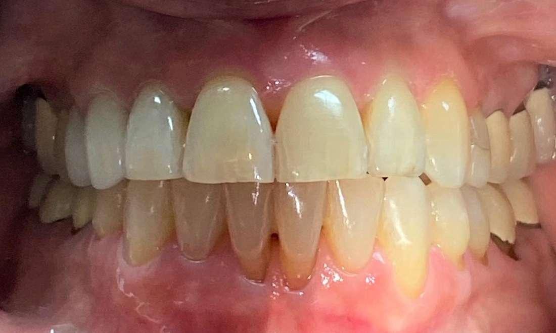 Front teeth after Invisalign