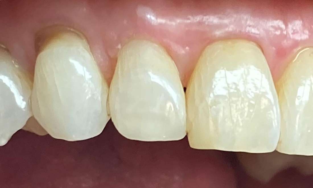 Before & After Photos, Cracked Tooth Repair Gallery