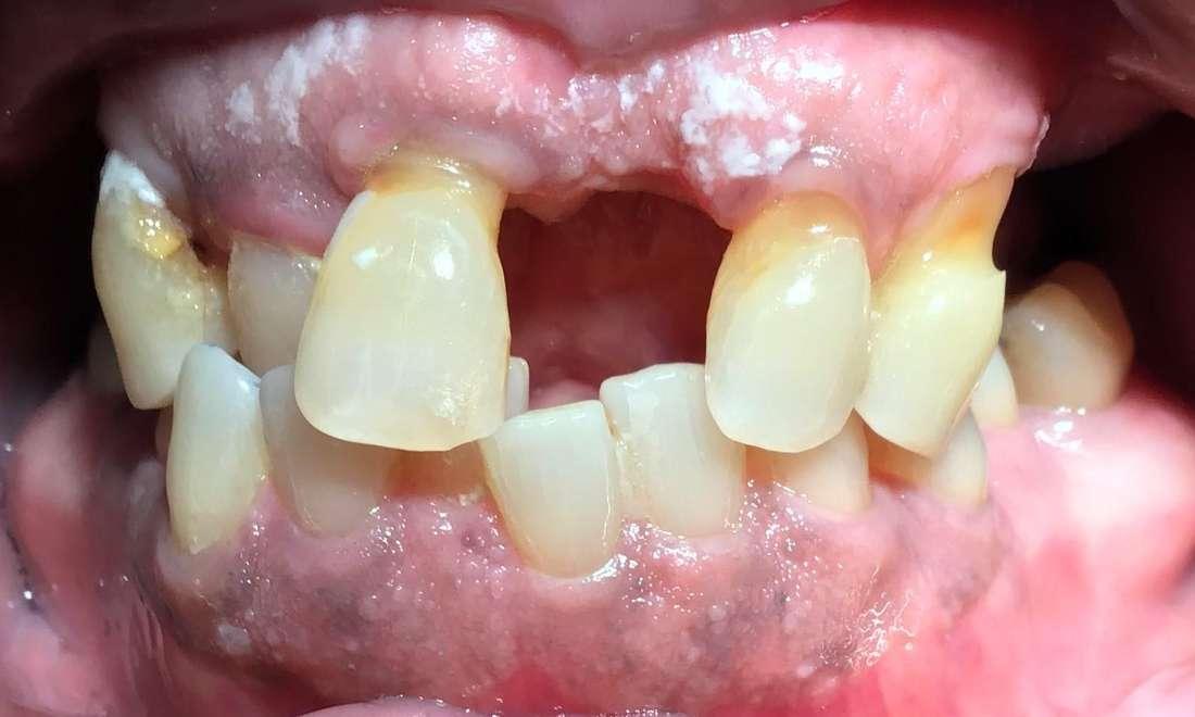 Before implant prosthetic