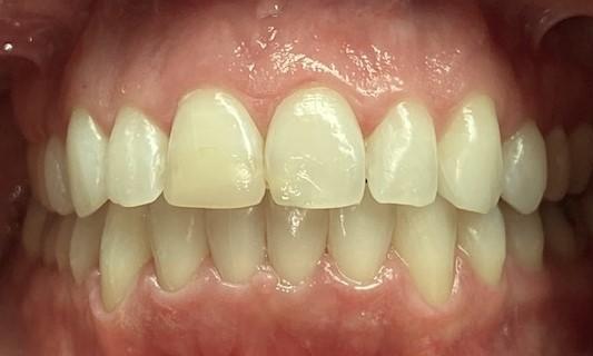 After Invisalign