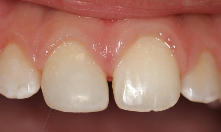 former broken toot fixed with composite resin