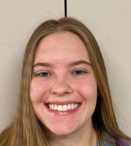 After Invisalign Treatment