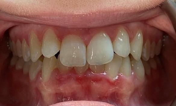 Deep Bite with Crowding