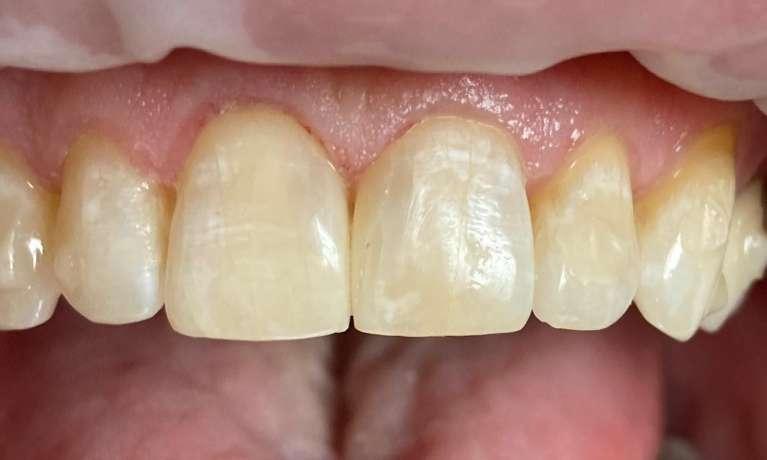 BioClear-Black-Triangle-Space-Closure-After-Image