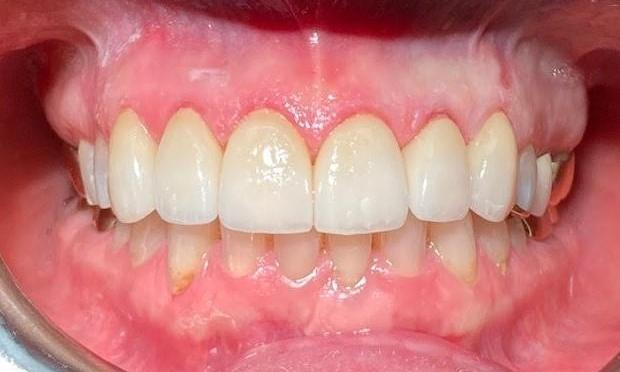 Full-Mouth-Rehab-After-Image
