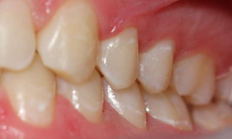 Icon-treatment-for-white-spots-on-teeth-After-Image