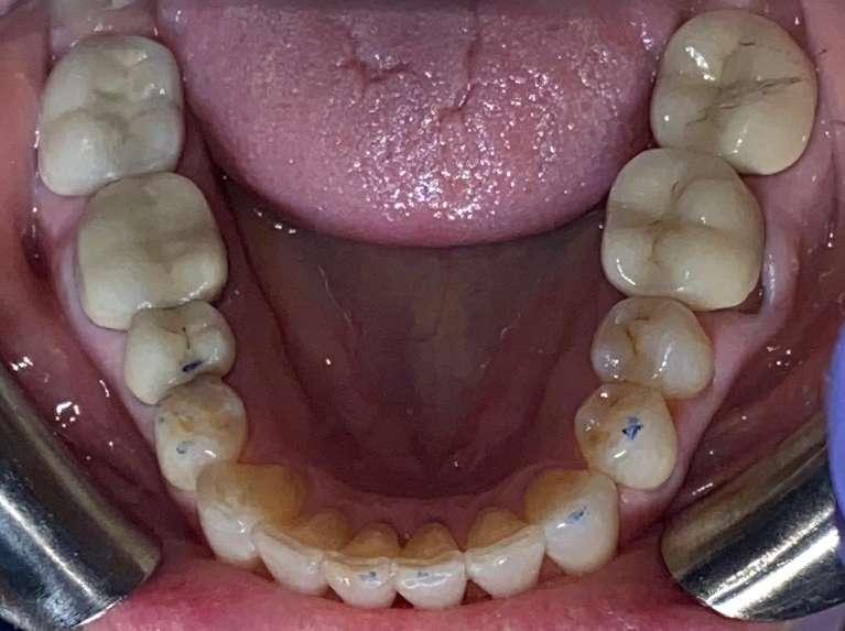 Lower teeth after Invisalign