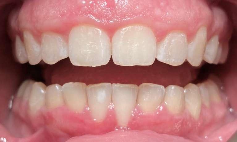Invisalign-for-deep-bite-and-prominent-front-teeth-After-Image
