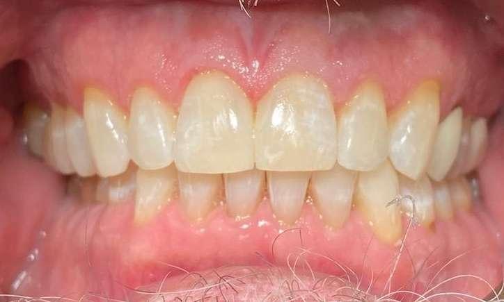 Gap closed by Invisalign