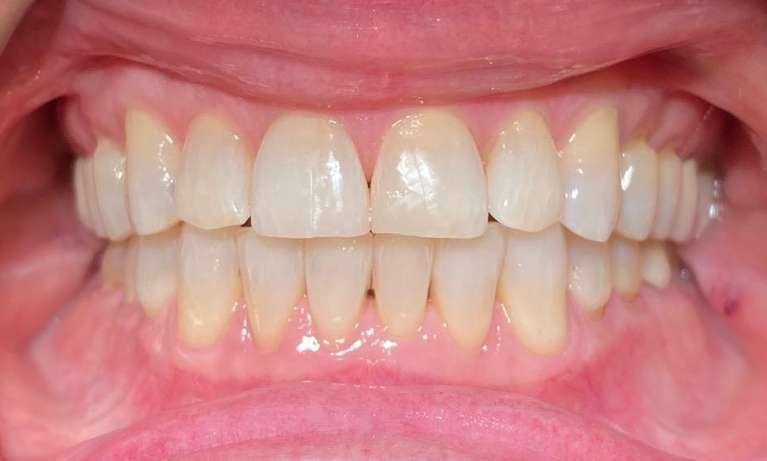 Invisalign-to-Prevent-Chipping-After-Image