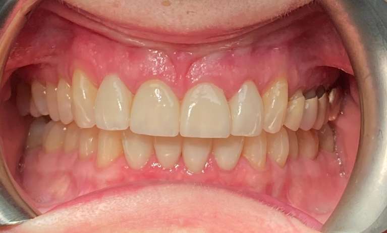 Smile-Makeover-using-Invisalign-and-Crowns-After-Image