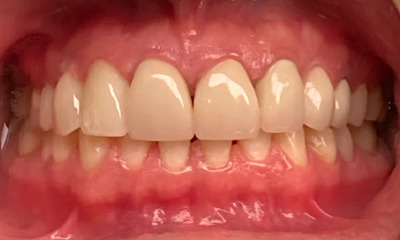 After treatment - This smile restoration changed his life!