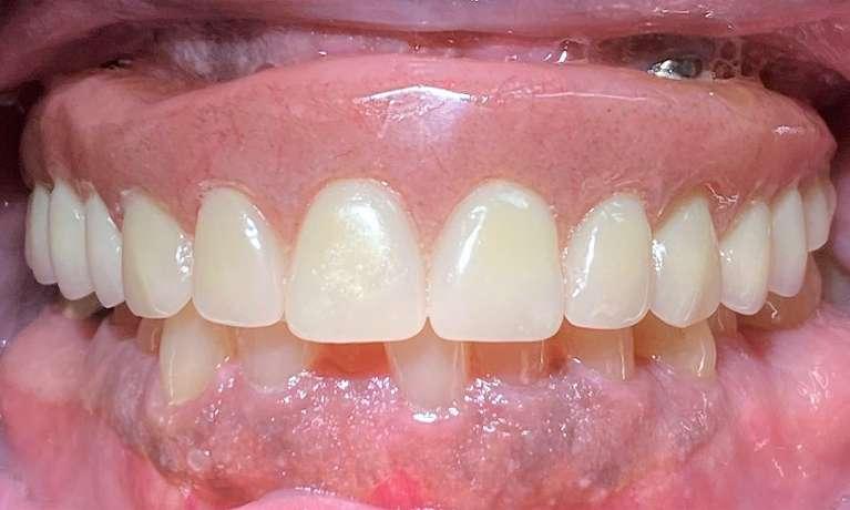 All-On-Four-Smile-Makeover-After-Image