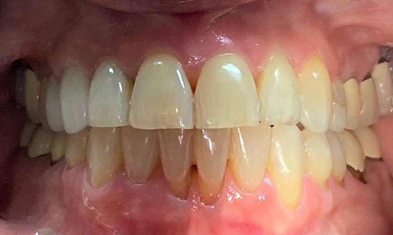 Front teeth after Invisalign