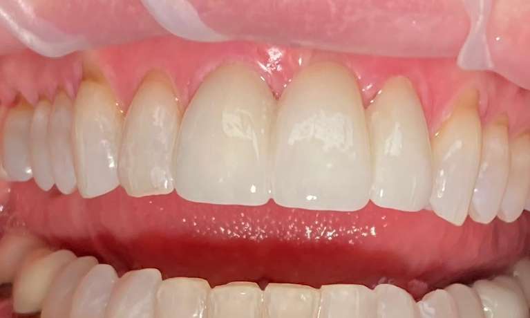 Porcelain-bridge-to-replace-a-missing-front-tooth-After-Image