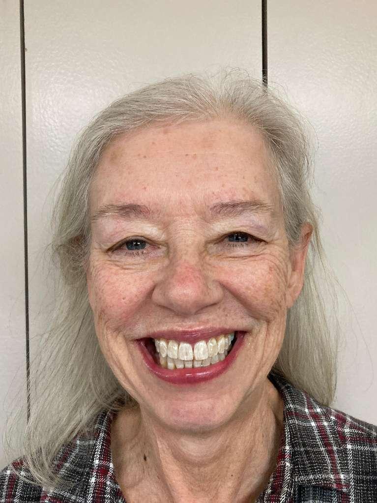 After Invisalign Smile