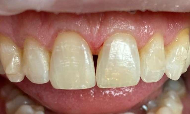 BioClear-Black-Triangle-Space-Closure-Before-Image