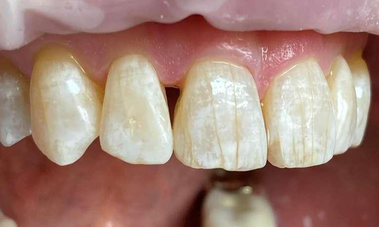 BioClear-to-close-gum-line-black-triangles-of-space-Before-Image