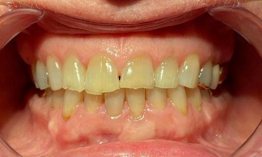 Full-Mouth-Rehab-Before-Image