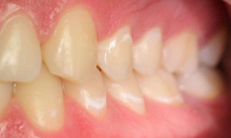 Icon-treatment-for-white-spots-on-teeth-Before-Image
