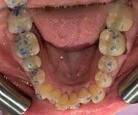 Lower teeth before Invisalign