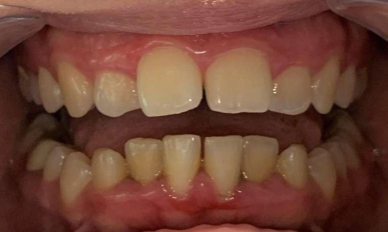 Invisalign-for-deep-bite-and-prominent-front-teeth-Before-Image