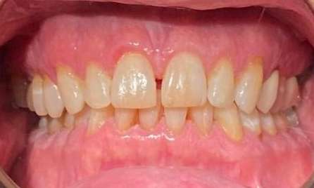 Gap in teeth before Invisalign