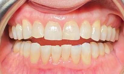 Invisalign-to-Prevent-Chipping-Before-Image