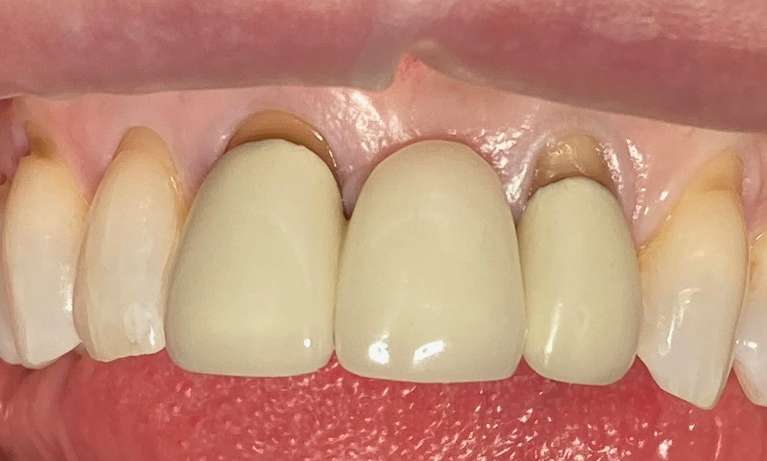 Porcelain-bridge-to-replace-a-missing-front-tooth-Before-Image