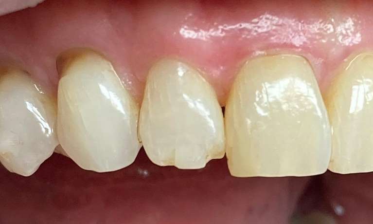 Repair-of-a-chipped-tooth-Before-Image