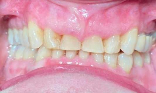 Smile-Makeover-using-Invisalign-and-Crowns-Before-Image