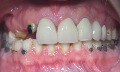 Before treatment - This smile restoration changed his life!