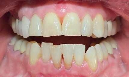 Front teeth before Invisalign